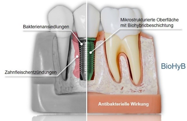 Mikrostrukturierung von Titanoberflächen zur Lebensdauersteigerung antibakterieller Biohybridbeschichtungen